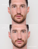 light-to-medium; Before & after of shade Light to Medium