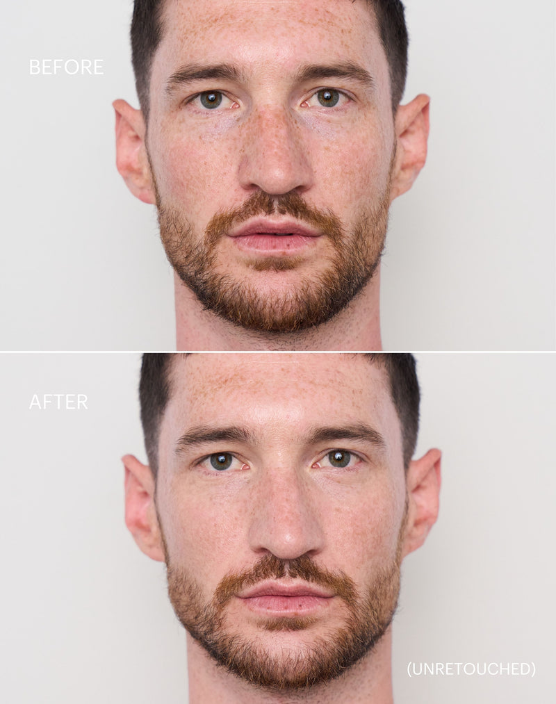 light-to-medium; Before & after of shade Light to Medium